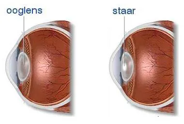 Oogkliniek Zeeland Staar Cataract