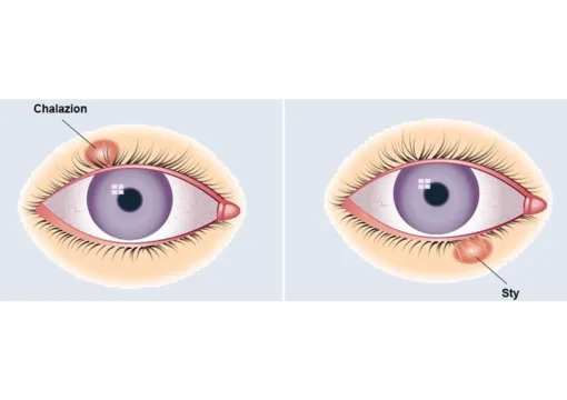 Chalazion – Zwelling Talgklier Folder Oogkliniek Zeeland