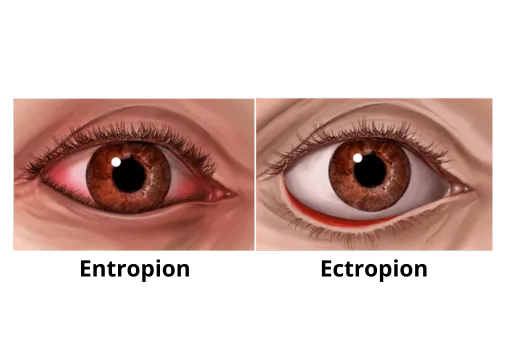 Ectropion En Extropion Folder Oogkliniek Zeeland