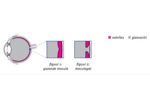 Maculagat Folder Oogkliniek Zeeland