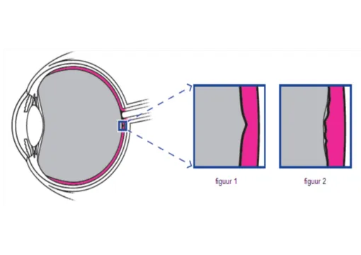 Maculapucker Folder Oogkliniek Zeeland