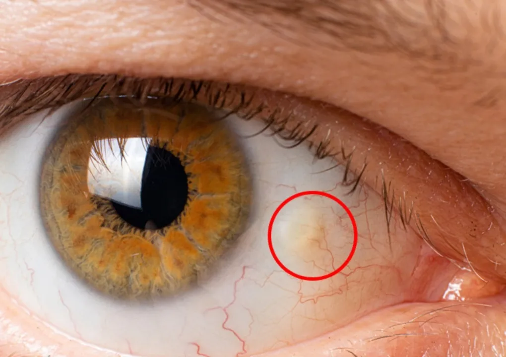 Oogkliniek Zeeland Lichtgele Zwelling Slijmvlies Oog (Pingueculum)