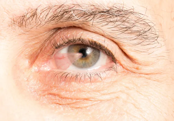 Oogkliniek Zeeland Pterygium Klachten En Symptomen