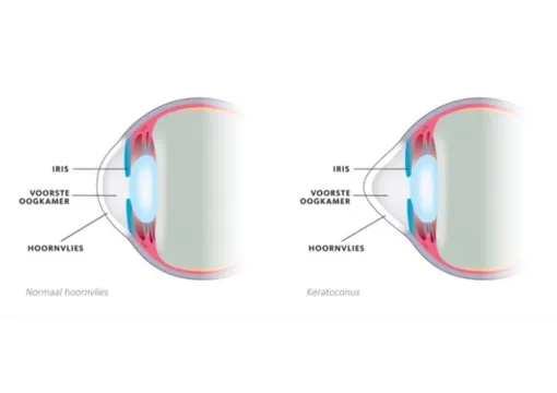 Oogkliniek Zeeland Folder Keratoconus