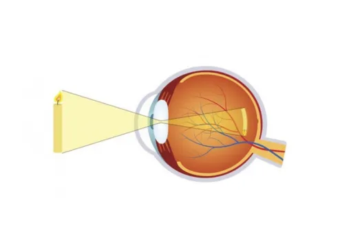 Refractieafwijkingen – Brilafwijkingen Folder Oogkliniek Zeeland