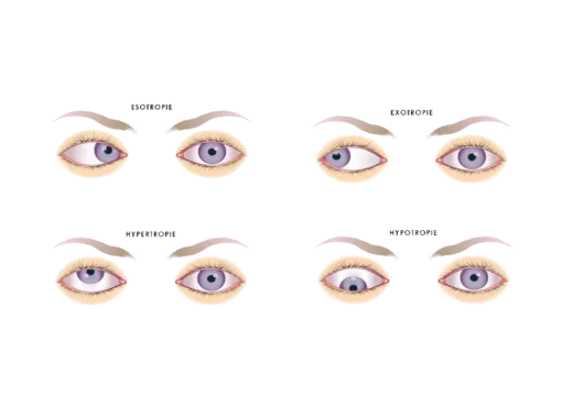 Soorten Scheelzien Oogkliniek Zeeland