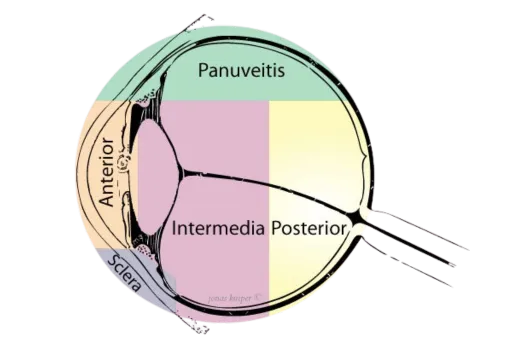Uveïtis Oogkliniek Zeeland