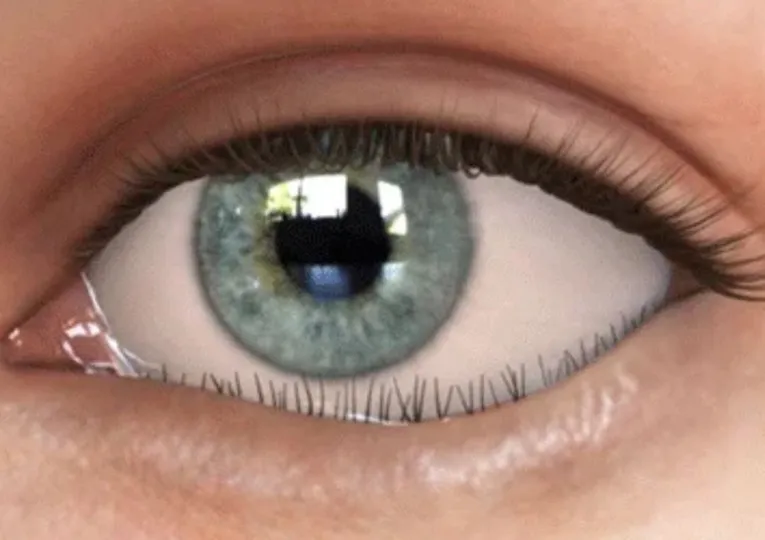 Entropion Oogkliniek Zeeland Detail