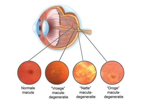 Vormen Maculadegeneratie Oogkliniek Zeeland