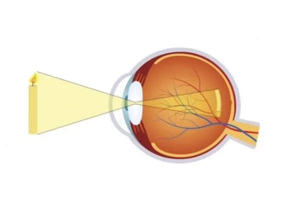 Oogkliniek Zeeland Folder Myopie