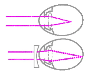 Myopie Oogklniek Zeeland Folder