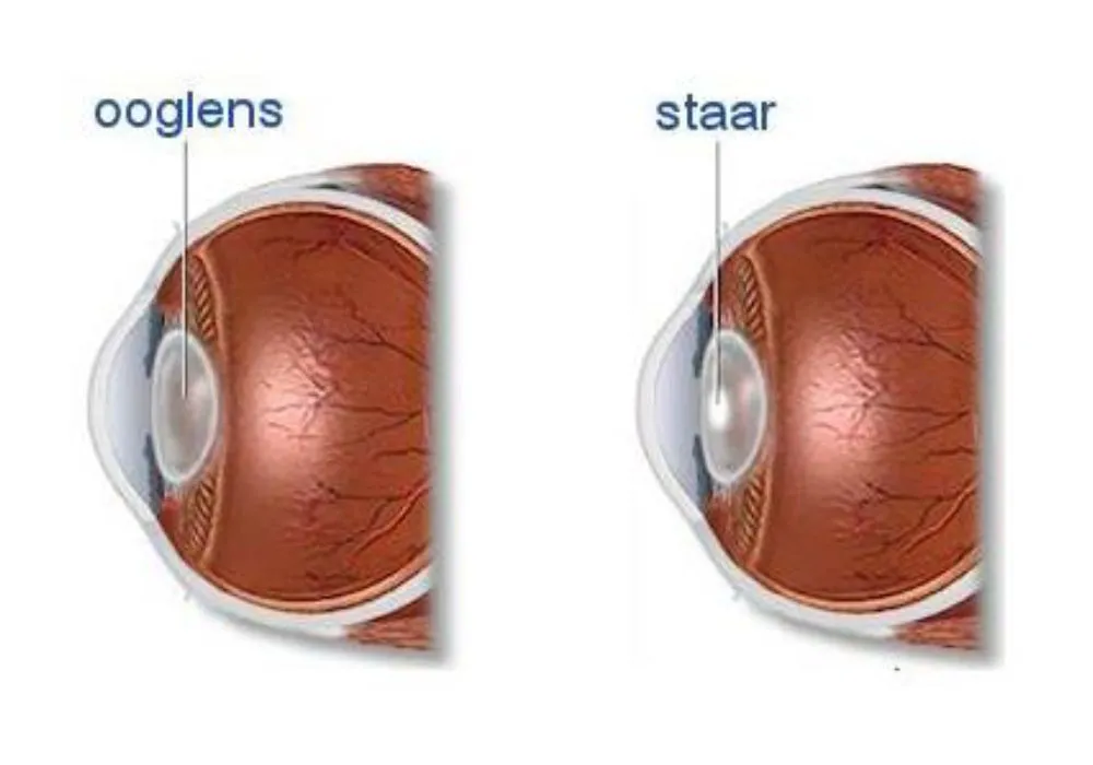 Staar Oogkliniek Zeeland Staaroperatie