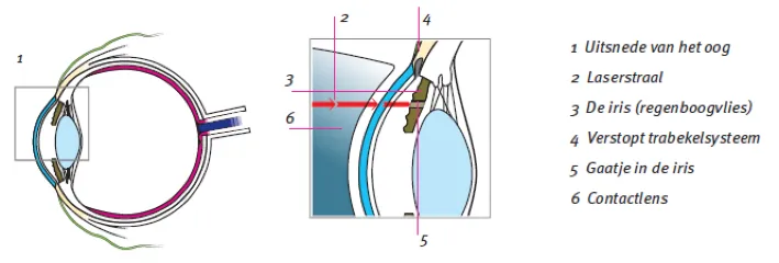 Laserbehandeling Oogkliniek Zeeland Folder